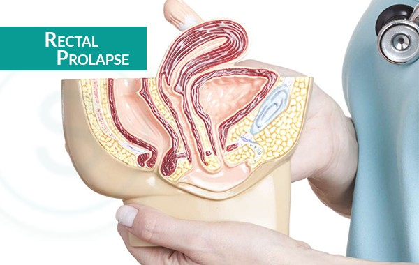 Rectal-Prolapse-Complications-600x380