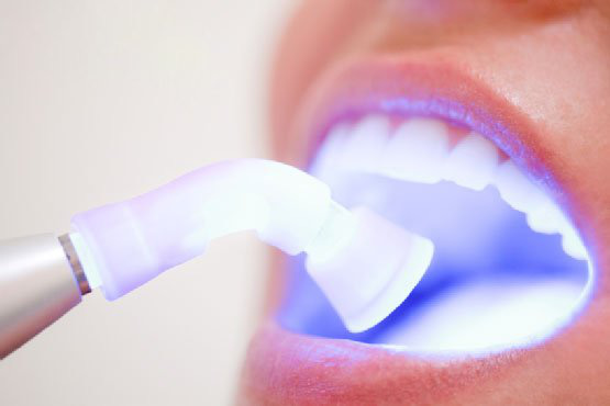 Tẩy trắng răng có hại gì với sức khỏe và có đau không? - Ảnh 4.