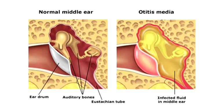 Viêm tai giữa cấp tính là gì và viêm tai giữa cấp tính điều trị như thế nào-3