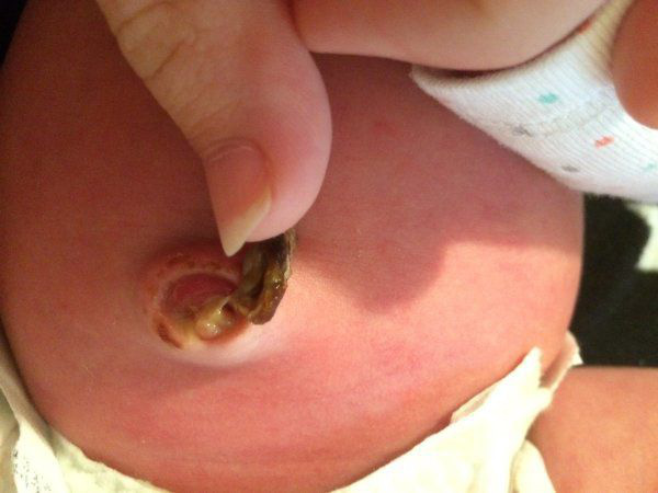 Hình ảnh rốn trẻ sơ sinh bị nhiễm trùng khiến nhiều mẹ sửng sốt  - Ảnh 3.