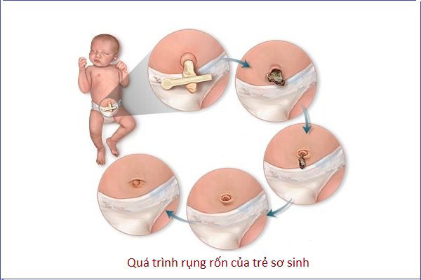 Hình ảnh rốn trẻ sơ sinh bị nhiễm trùng khiến nhiều mẹ sửng sốt  - Ảnh 6.