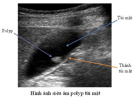 Hình ảnh siêu âm polyp túi mật