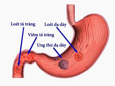 viem-ta-trang-la-gi-hieu-dung-benh-chua-dung-cach-6