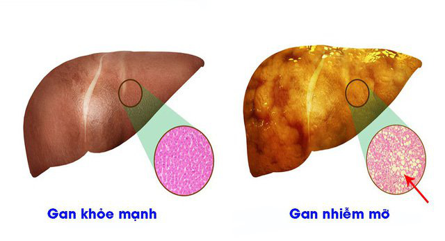 Gan nhiễm mỡ độ 1 là gì? Gan nhiễm mỡ độ 1 có nguy hiểm không? - Ảnh 2.