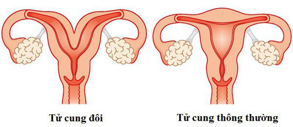 Mẹ đẻ xong gần tháng vẫn thấy bụng &quot;động đậy&quot;, bác sĩ bàng hoàng phát hiện còn sót 2 bé - Ảnh 2.