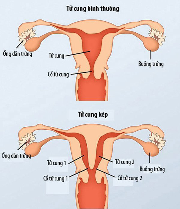 Mẹ Phú Thọ có 2 tử cung mang bầu, sinh non 35 tuần, em bé chưa được 2kg - Ảnh 2.