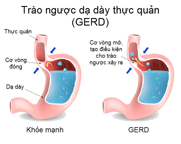 Bệnh trào ngược dạ dày thực quản có lây không? - Ảnh 2.