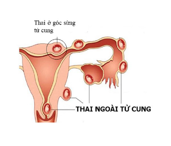 Mẹ Sài Gòn mang thai đôi, vỡ thai ngoài tử cung mất 2,3 lít máu vẫn may mắn giữ được một bé - Ảnh 2.