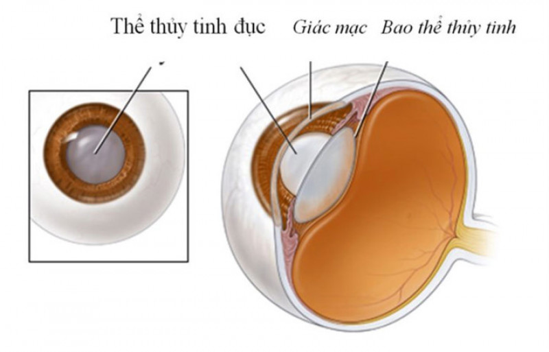 Ngăn ngừa đục thủy tinh thể: Một nghiên cứu kết luận rằng vải có thể giúp ức chế đục thủy tinh thể. Vải có chứa phytochemicals có tính chất chống oxy hoá và chống ung thư. Điều này có nghĩa là chúng giúp ngăn ngừa sự phát triển bất thường của tế bào, giúp ngăn ngừa đục thủy tinh thể.