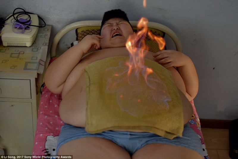 Đây là hình ảnh của một cậu bé bị béo phì tên Li tại Trung Quốc. Vào năm ngoái, cậu bé này đã phải vào trung tâm giảm cân của thành phố Trường Xuân. Tại đây, cậu bé đã trải qua những biện pháp trị liệu truyền thống khắt khe và biện pháp châm lửa này là một ví dụ điển hình. 