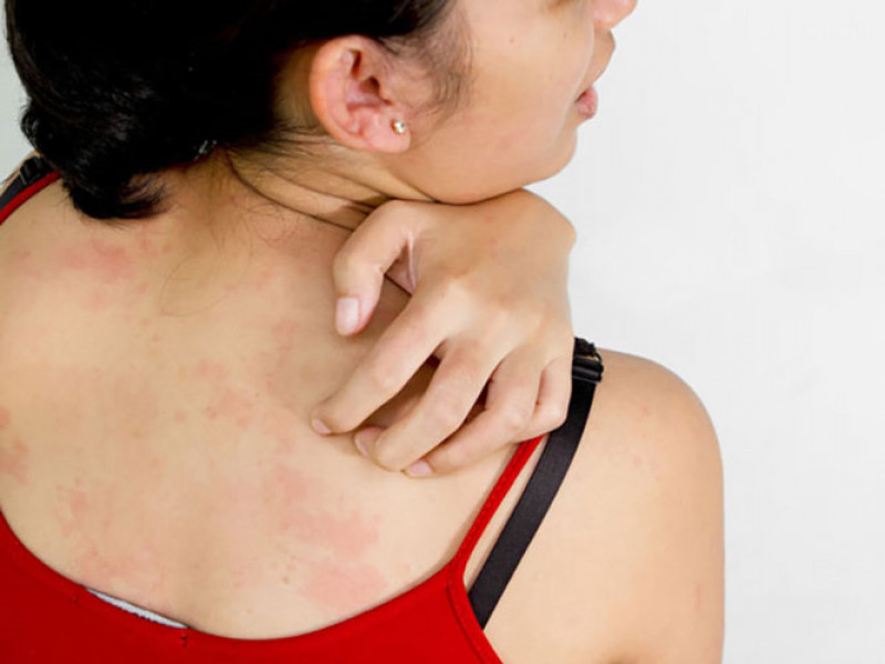 Có thể điều trị bệnh Eczema (chàm): Eczema là một tình trạng trong đó da của một người trở nên ngứa, viêm và dễ bị kích thích. Rất nhiều phụ nữ sử dụng nước gạo để trị các triệu chứng khó chịu của tình trạng này. Hãy thử sử dụng nước gạo trong chế độ chăm sóc da của bạn để phòng ngừa bệnh eczema.