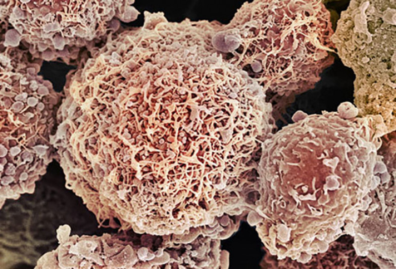Ung thư cổ tử cung: Với các xét nghiệm Pap thường xuyên, ung thư cổ tử cung rất dễ ngăn ngừa. Cổ tử cung là một lối đi hẹp giữa tử cung và âm đạo. Xét nghiệm Pap sẽ tìm thấy các tế bào bất thường trên cổ tử cung, có thể được loại bỏ trước khi chúng biến thành ung thư. Nguyên nhân chính của ung thư cổ tử cung là do vi rút HPV gây nên.