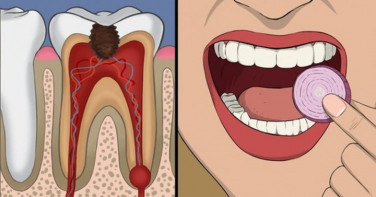 Hành tây: Bạn chỉ cần cắt ra một mảnh hành tây phù hợp cho vào trong miệng và đặt nó trên khu vực bị ảnh hưởng do đau răng. Hành tây có đặc tính khử trùng và chống viêm giúp loại bỏ vi khuẩn ra khỏi miệng và giảm thiểu cơn đau.