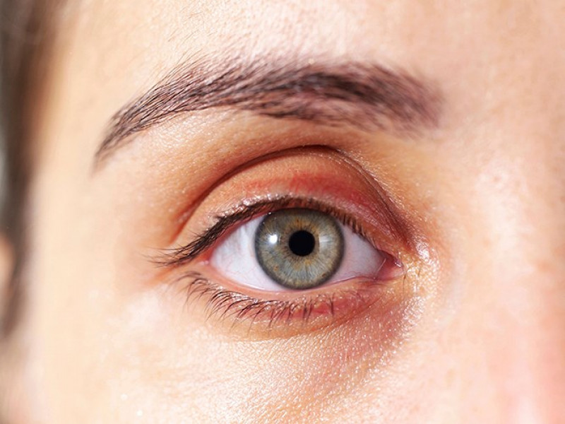 U vàng hay ban vàng mi mắt: U vàng thường không đau và không gây hại và có thể có tính chất di truyền. Tuy nhiên, trong một số trường hợp, hiện tượng này là dấu hiệu của tình trạng cholesterol trong máu cao, báo hiệu nguy cơ bệnh xơ vữa động mạch.