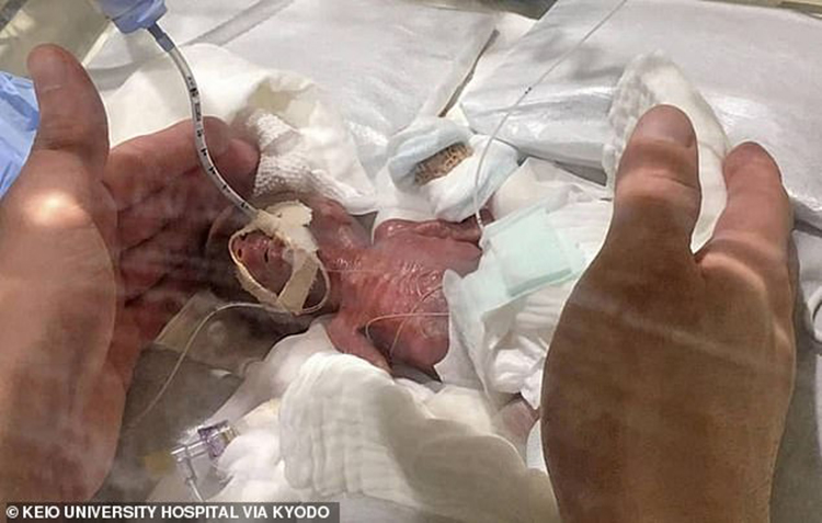 Đây được xem là một điều kỳ diệu trong lịch sử y học vì em bé sinh non đến gần 3,5 tháng và nặng chưa bằng 1/10 bé sơ sinh bình thường. Tháng 8/2018, bé trai sinh non bằng phương pháp mổ đẻ khi mẹ của bé đang mang thai ở tuần thứ 24. Lúc đó, cậu bé có thể nằm gọn trong hai lòng bàn tay người lớn và chỉ nặng hơn quả cam một chút. Khi chào đời, cậu bé đã phải hỗ trợ thở máy và đặt catheter cuống rốn để truyền dịch.