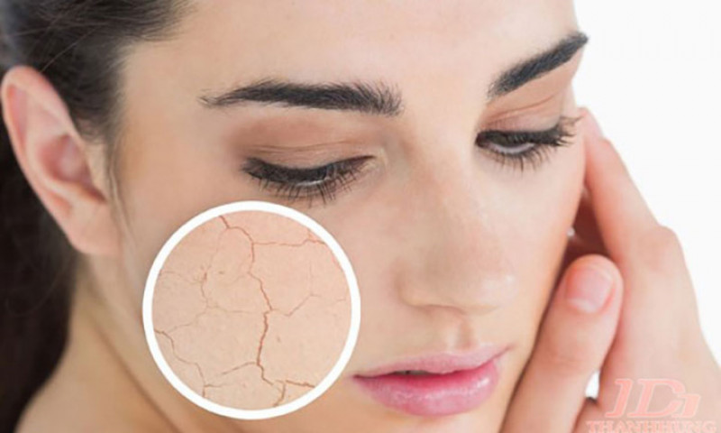 Da khô: Các tế bào da cần được giữ ẩm. Da khô là một trong những triệu chứng chính của mất nước. Da khô sẽ tiếp tục lan rộng và làm nhăn da nếu không được bổ sung nước.