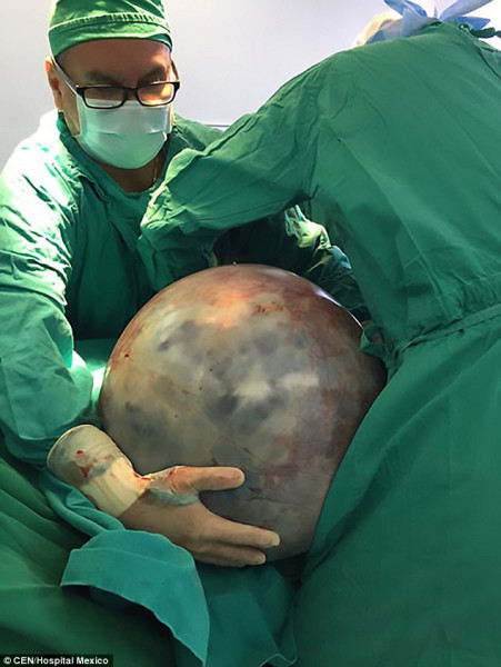 Sau khi tiến hành cuộc phẫu thuật cho bà Sonia, các bác sĩ tại đây cho biết, khối u này đã phá kỷ lục thế giới vì kích thước và trọng lượng đặc biệt của nó.