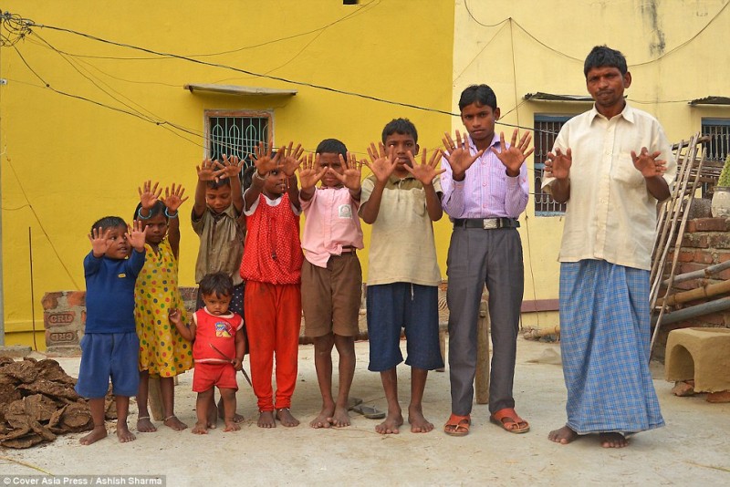 Gia đình của ông Krishna Choudhary sống trong ngôi làng nhỏ ở vùng Gaya, thành phố Bihar, miền Bắc Ấn Độ, gồm có 25 thành viên. Tất cả những thành viên này đều có 6 ngón tay và 6 ngón chân ở mỗi bàn tay/chân. Điều này khiến gia đình ông trở nên nổi tiếng khắp vùng.