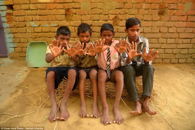 Từ trái qua phải là Raju Choudhary 11 tuổi, Pintu Choudhary 10 tuổi, Pawan Choudhary 10 tuổi, và Sunny Choudhary 14 tuổi. Bốn cậu con trai của ông Krishna đều có 12 ngón tay và 12 ngón chân.