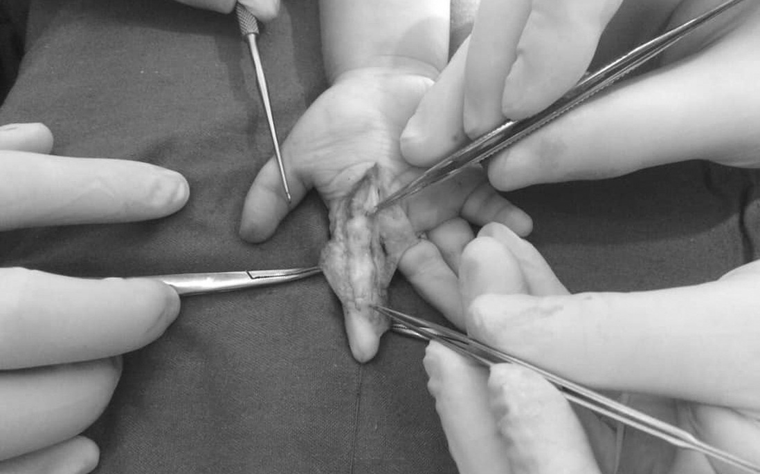 Bé 1 tuổi nắm phải sâu róm, gia đình đắp thuốc Nam khiến trẻ suýt phải cắt bỏ ngón tay