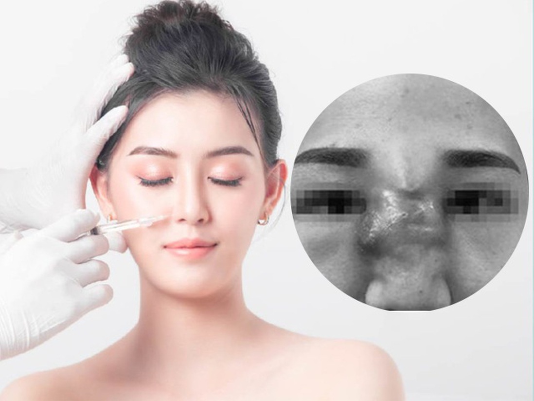 Mắc phải những sai lầm tai hại này khi tiêm filler, chị em có thể phá huỷ cả gương mặt