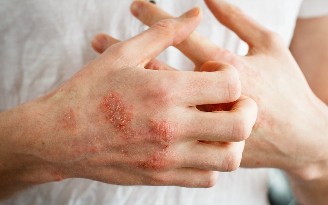 Những yếu tố nào làm tăng nguy cơ bị bệnh nấm da?