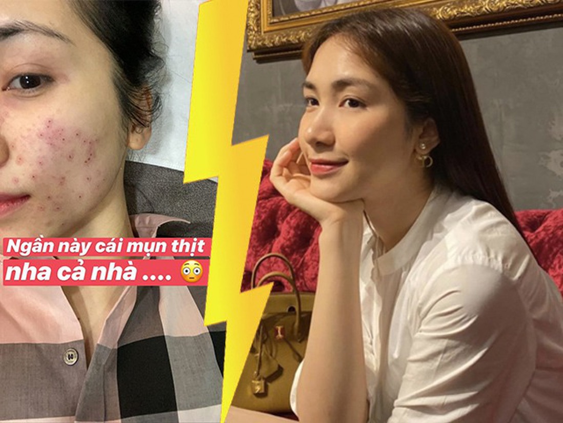 Học Hòa Minzy cách "đuổi" sạch mụn nhờ skincare hơn 1 tiếng mỗi ngày