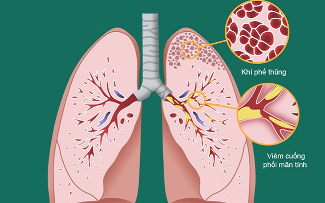 Những điều cần biết về phổi tắc nghẽn mãn tính giai đoạn 2