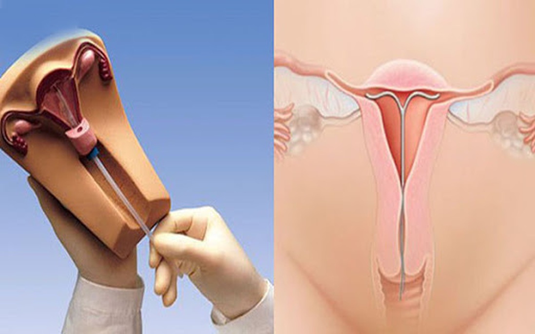 Bác sĩ phụ khoa giải đáp: Có bao nhiêu loại vòng tránh thai và những ai không nên tránh thai bằng cách này