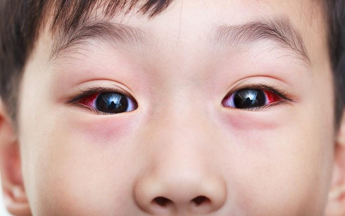 Đau mắt đỏ nên ăn gì? Những thực phẩm tốt cho những người bị đau mắt đỏ