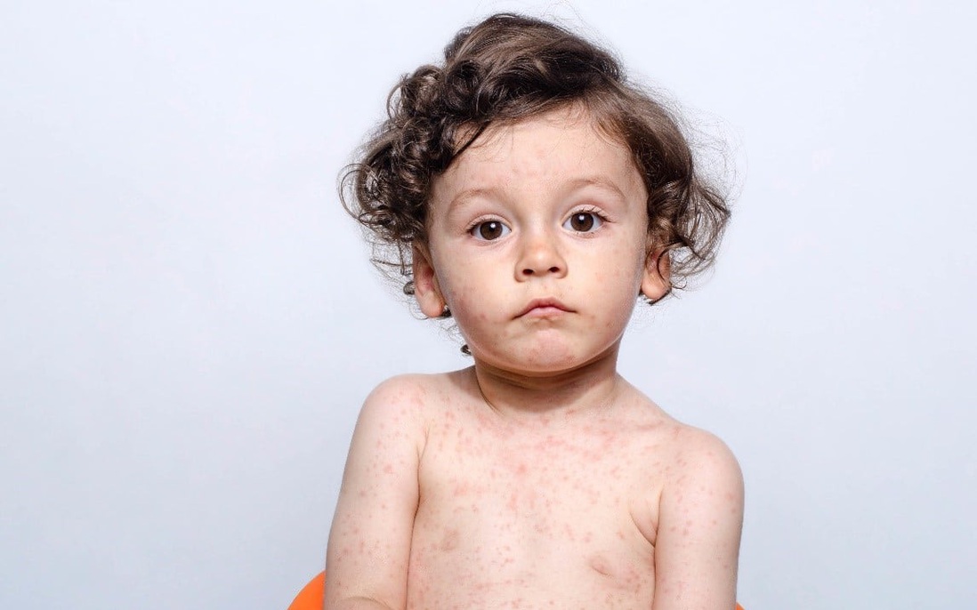 Dựa vào dấu hiệu bệnh sởi để phân biệt với sốt phát ban, Rubella và thuỷ đậu