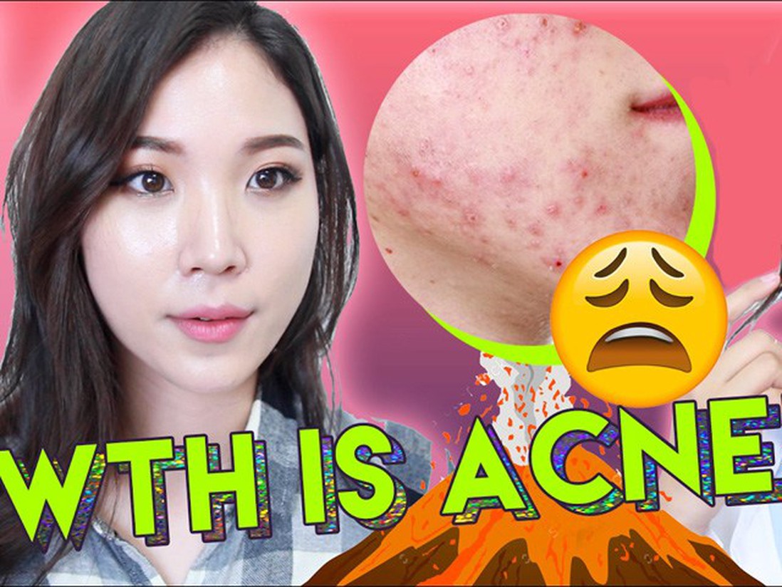Beauty blogger Hàn chia sẻ nên và không nên ăn gì khi làn da bị mụn