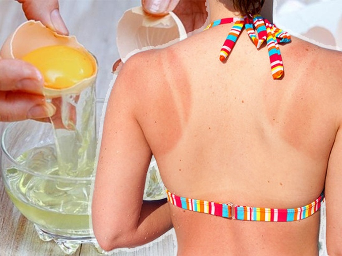 Áp dụng 5 cách chăm sóc da bị cháy nắng đơn giản giúp da lên tông nhanh chóng