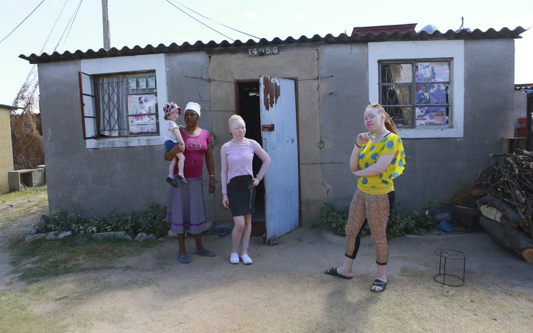 Những người bạch tạng ở Zimbabwe đối mặt với sự kỳ thị trong mùa Covid-19