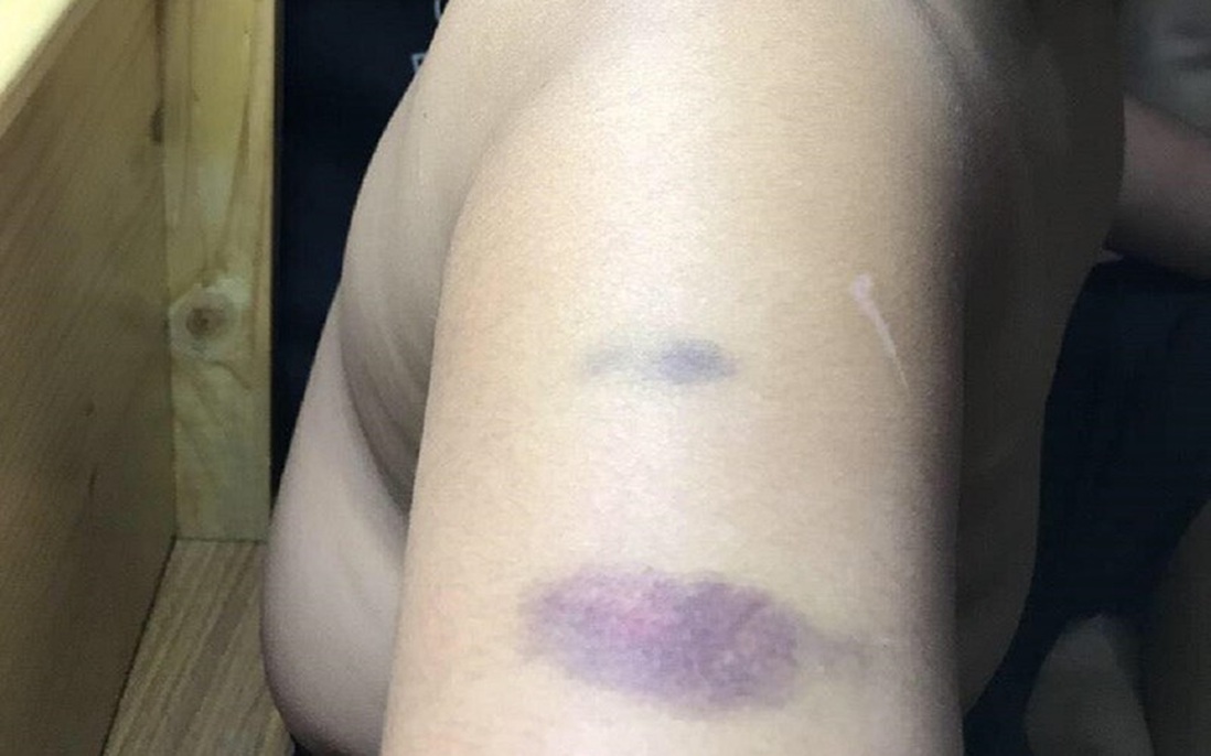 TPHCM: Một học sinh trường Quốc tế bị cô giáo đánh bầm tím tay