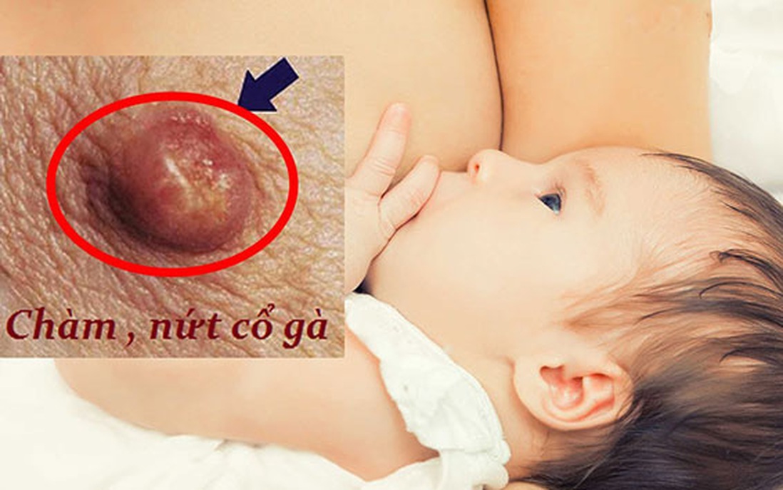 Cách chữa nứt cổ gà khi cho con bú mà mẹ cần biết