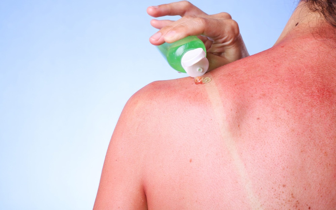 Vết cháy nắng có thể tồn tại trên da bao lâu và biện pháp làm dịu, phục hồi da nhanh hơn
