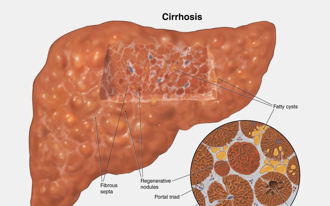 Xơ gan: Triệu chứng, nguyên nhân, cách điều trị và phòng tránh