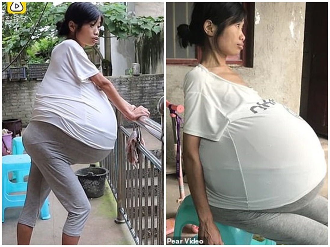 Người phụ nữ mang "bụng bầu" nặng 20kg suốt 2 năm mà không rõ nguyên nhân