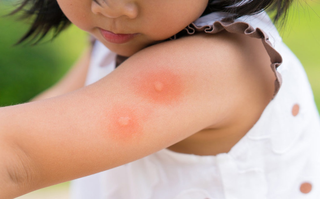 8 sai lầm cha mẹ cần tránh khi chăm sóc trẻ bị sốt xuất huyết 