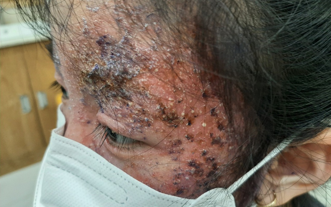 Gương mặt bé gái 8 tuổi sần sùi, mưng mủ vì điều trị nấm da sai cách
