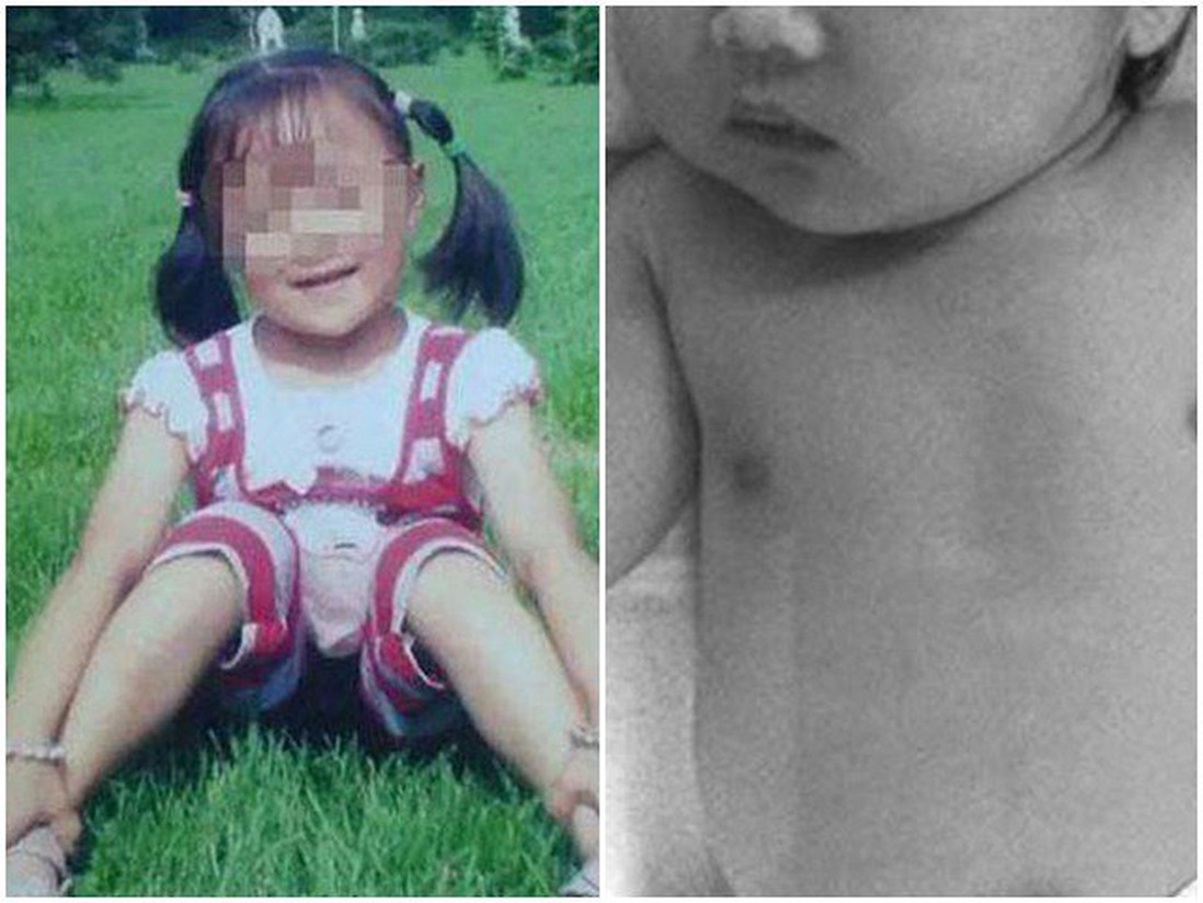 Chị ném em từ tầng 5 vì câu nói "Mẹ cho cháu ra rìa vì mẹ đã có em trai"