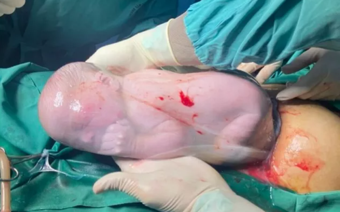 Cặp song sinh chào đời, một bé còn nằm nguyên trong bọc ối