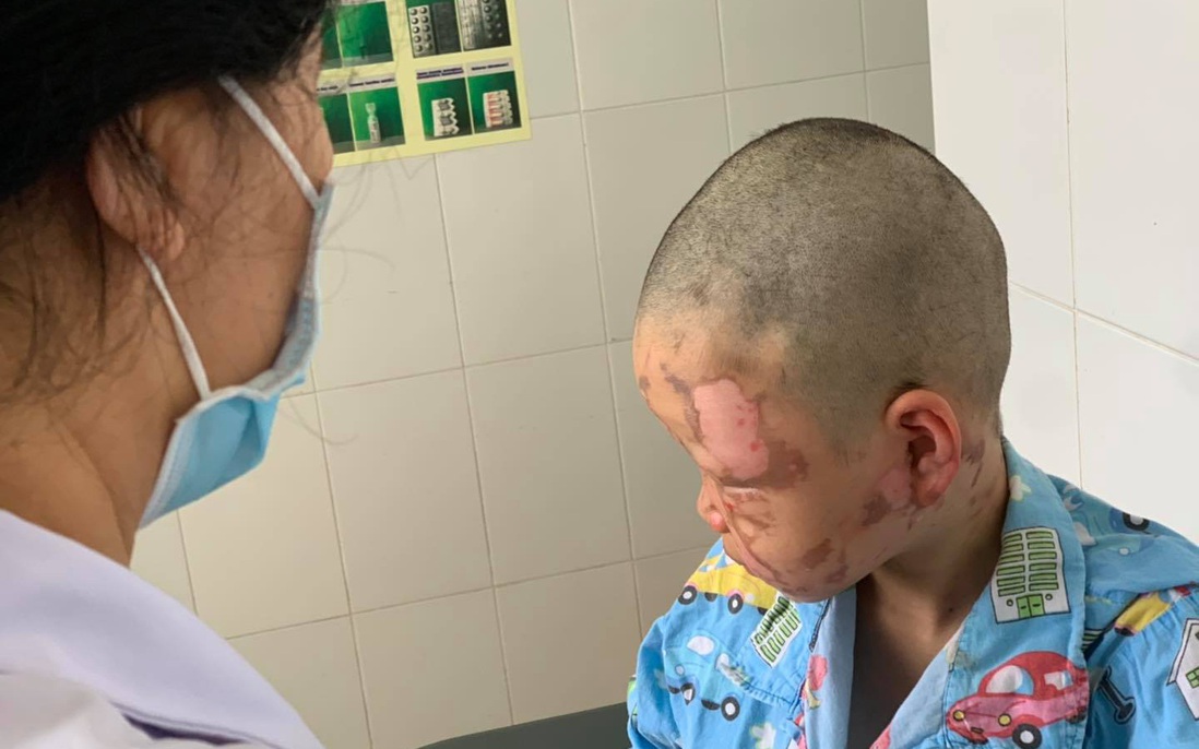 Đốt cồn theo clip trên mạng, bé 10 tuổi bị bỏng toàn bộ vùng mặt 