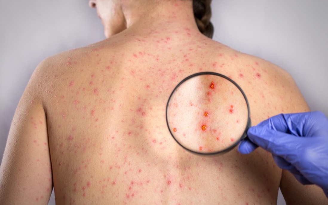 Điểm mặt 5 sai lầm khi điều trị bệnh Rubella bệnh nhân cần tránh