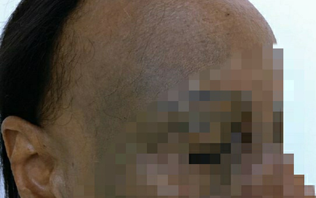 Bệnh hiếm khiến người phụ nữ 7 năm điều trị rụng tóc nửa đầu không thuyên giảm