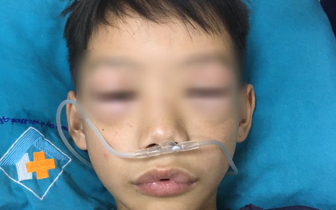 Uống thuốc tự mua, bé 10 tuổi ở Phú Thọ bị sốc phản vệ phải cấp cứu