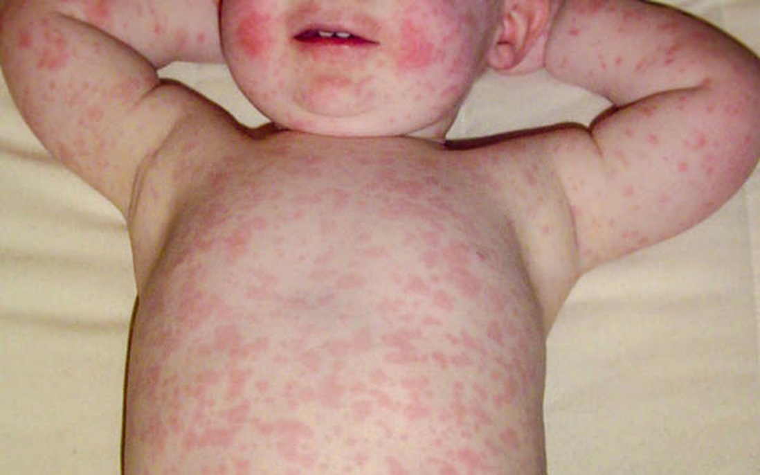 Tổng hợp các triệu chứng bệnh Rubella phổ biến nhất