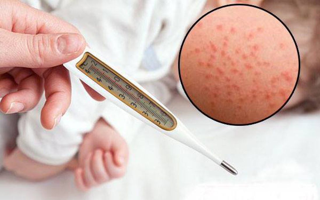 Điểm danh 3 sai lầm khi chăm sóc người bệnh Rubella thường gặp