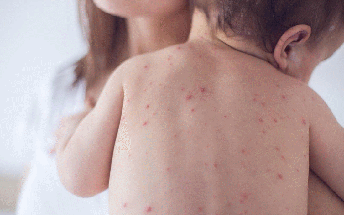 Những việc cần lưu ý khi chăm sóc và hỗ trợ điều trị bệnh Rubella